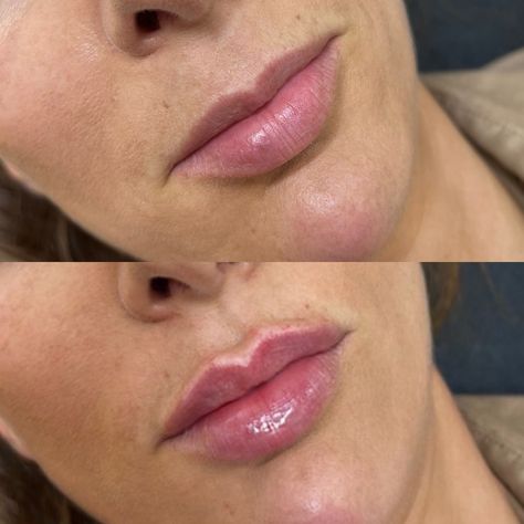 Bringing the tip lip into proportion woth the botton, lifting and defining the cupids bow 🙌🏼 #aestheticsessex #aestheticsbenfleet #lipfilleressex #lipfillerbenfleet #dermalfillerbenfleet #dermalfilleressex #benfleet #essex #russianlips #russianliosbenfleet #russianlipsessex #lipenhancement #lipenhancementbenfleet #lipenhamcementessex #lipaugmentation #lipaugmentationessex #lipaugmentationbenfleet #aestheticsbykatie #aestheticsbykatiexx #aestheticsbykatiebenfleet #naturallipfiller #naturallio... Cupid Bow Lips, Bow Lips, Cupids Bow Lips, Cupid Bow, Lip Augmentation, Lip Enhancement, Cupids Bow, Perfect Lips, Dermal Fillers