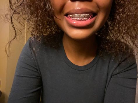 Braces with rubber bands Braces Colors With Rubber Bands, Braces Colors Black Women, Braces Hot Pink, Red Rubber Bands Braces, Braces With Rubber Bands, Braces With Power Chains, Braces Power Chain, Braces Pink Bands, Pink Power Chain Braces