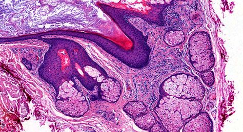 Dermatopathology Case 221 Sebaceous Hyperplasia, Science Artwork, Histology Slides, Medical Laboratory Technician, Basal Cell, Laboratory Technician, Micro Photography, Medical School Motivation, Medical Laboratory