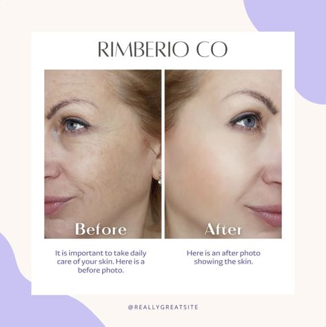 Purple and Beige Before and After Skincare Instagram Post Before And After Social Media Design, Before After Social Media Post, Before And After Poster Design, Before And After Instagram Post Design, Before After Skincare, Before And After Skincare, Mouth Wrinkles, Jade Rollers, Purple And Beige