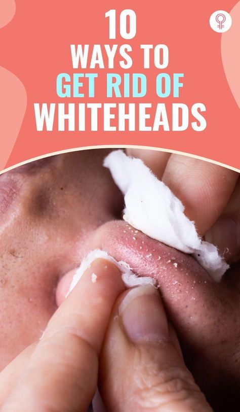 Whiteheads are a common skin condition that can be unsightly and even painful. Luckily, there are many natural ways to get rid of whiteheads without resorting to harsh chemicals or expensive treatments.

Here are :

 Wash your face with warm water and a gentle cleanser twice a day. This will help to remove dirt, oil, and bacteria that can clog pores and lead to whiteheads.
 Use a toner to help balance the pH level of your skin. White Heads On Nose, Nails Remedies, Natural Hair Removal Remedies, Diy Nail Care, Different Types Of Acne, Prevent Pimples, Blackheads On Nose, Clean Blackheads, Get Rid Of Pimples