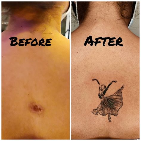 Appendix Scar Tattoo Cover Up, Scar Tattoo Cover Up, Scar Cover Up Tattoo, Scar Cover Tattoo, Leg Scars, Scars Tattoo, Tattoo Over Scar, Scar Cover Up, Tattoos To Cover Scars