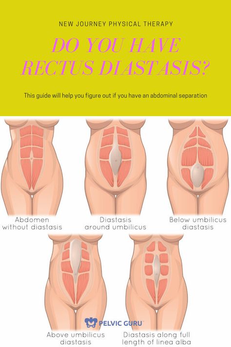 Do I have rectus diastasis? How to know if you have a gap and to start the recovery process Diastasis Recti Looks Like, How To Check For Diastasis Recti, How Do You Know If You Have Diastasis Recti, How To Fix Diastasis Recti Years Later, Correcting Diastasis Recti, Severe Diastasis Recti, How To Avoid Diastasis Recti, Diastis Recti Before And After, Ab Separation Diastasis Recti Exercise