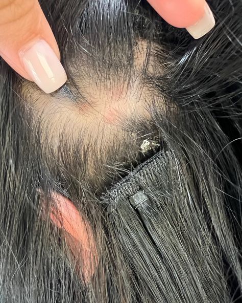 ‼️ Did you catch my post about traction alopecia the other day? I wanted to share another example from one of my recent extension consultations. Here’s what I noticed in the early stages of traction alopecia: 😣 Irritated, red, and sore scalp 😬 Extensions slipping 😳 Thinning patches and bald spots 🚨 Follicle damage ⚖️ Extensions feeling way too heavy at the track ends 😕 Early signs of scarring 💔 Hair being pulled from areas that just can’t support extensions anymore Here’s how I’d handle the... Alopecia Photography, Alopecia Artwork, Traction Alopecia Hairstyles, Sores On Scalp, Alopecia Awareness, Traction Alopecia, Bald Spot, Hair