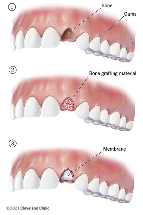 Dental Bone Graft: Process, Healing & What It Is Maxillary Sinus, Denture Implants, Best Dental Implants, Dental Implant Surgery, Bone Grafting, Pinterest Tutorials, Oral Surgeon, Tooth Replacement, Restorative Dentistry