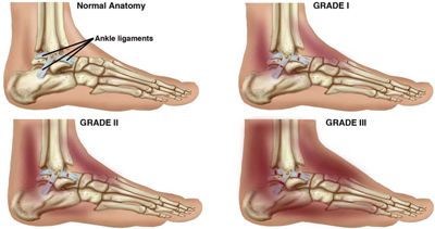 AnkleSprains-Small Strained Ankle, Ankle Ligaments, Twisted Ankle, Ankle Sprain, Swollen Ankles, Broken Ankle, First Second Third, Ankle Pain, Foot Injury