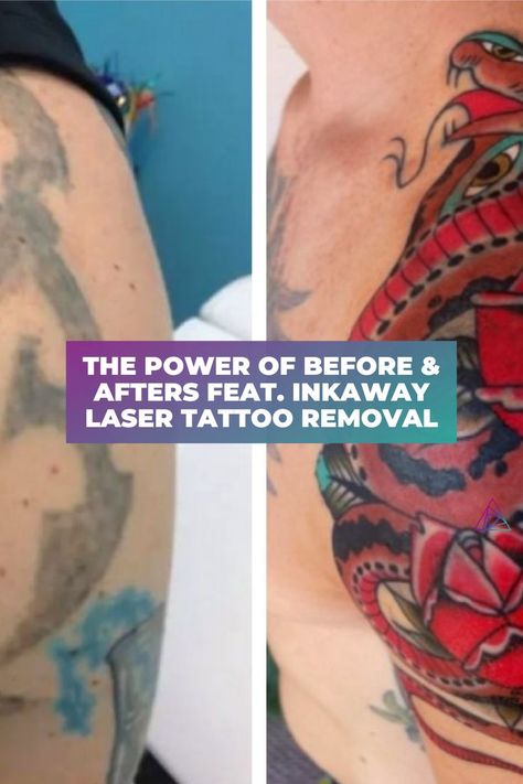 InkAway Laser Tattoo Removal won the Best Completed Tattoo Removal and Best Tattoo Removal Lightening and Cover-Up categories in 2021. In addition, we recently interviewed Stephanie Sapp, an InkAway laser specialist, to learn more about InkAway's journey and how they've positively impacted their community with this laser service. Keep reading to learn more about the power of before and after photos and to see InkAway's winning contest photos. Laser Tattoo Removal Before And After, Tattoo Removal Before And After, Aesthetic Business, Red Tattoos, Laser Tattoo, Laser Tattoo Removal, Tattoo Removal, After Photos, Best Tattoo