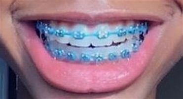 Light Blue Braces, Dental Braces Colors, Braces Colors Combinations, Invisible Teeth Braces, Blue Braces, Natural Teeth Whitening Diy, Cute Braces Colors, Pretty Teeth, Kids Braces