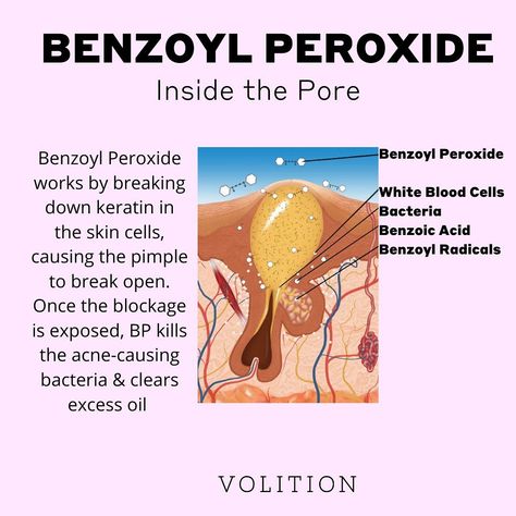 Volition Beauty on Instagram: “Benzoyl Peroxide is a great ingredient for treating acne. Learn more about how it works!” Study Esthetics, Volition Beauty, Esthetician Business, Sunscreen For Sensitive Skin, Integumentary System, Treating Acne, Skin Facts, Skin Aesthetics, Treat Acne