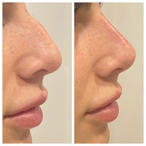 Dr. Leslie Gerstman on Instagram: “Just a little fine tuning of my clients nose with some filler 👏👏👏 #dermalfillers #fillers #cheekfillers #teartroughfillers #chinfiller…” Tinkerbell Nose Filler, Nose Filler, Nose Fillers, Chin Filler, Cheek Fillers, Cosmetic Injectables, Dermal Fillers, Beauty Body, Vision Board