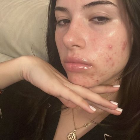 fernanda Acne Aesthetic Girl, Acne Girls Pretty, Pretty With Acne, Acne Embrace, Models With Acne, Acne Is Beautiful, Normalize Acne, Pretty People With Acne, Girls With Acne