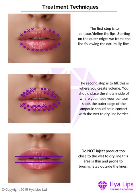 Lip Blush Mapping, Lip Mapping Hyaluron Pen, Hyaluronic Pen Lips, Hyaluron Pen Lip Filler Mapping, Hyaluron Pen Lip Filler, Lip Filler Mapping, Hyaluron Pen Lip Mapping, Face Injections, Dermal Fillers Lips