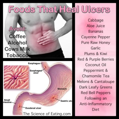 Ulcers are painful, open sores that develop on the lining of the stomach, small… Foods For Ulcers, Ulcer Diet, Stomach Ulcers, Stomach Issues, Healing Food, Acid Reflux, Health Info, Cool Stuff, Body Health