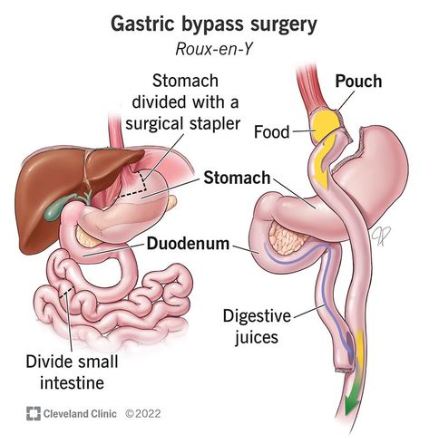 Bile Reflux, Dumping Syndrome, Bariatric Friendly Recipes, Laparoscopic Surgery, Bypass Surgery, Liquid Diet, Nutritional Deficiencies, Gastric Bypass, After Surgery