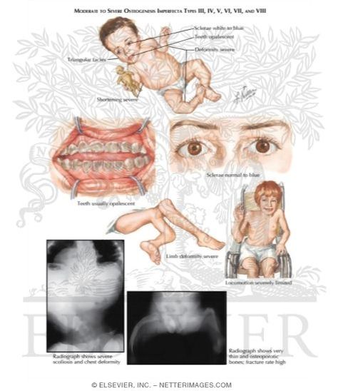 osteogenesis imperfecta | Osteogenesis Imperfecta Osteogenesis Imperfecta, Medical Images, Integumentary System, Bone Diseases, Strong Bones, Maternity Nursing, Pediatrics, Disease, Bones