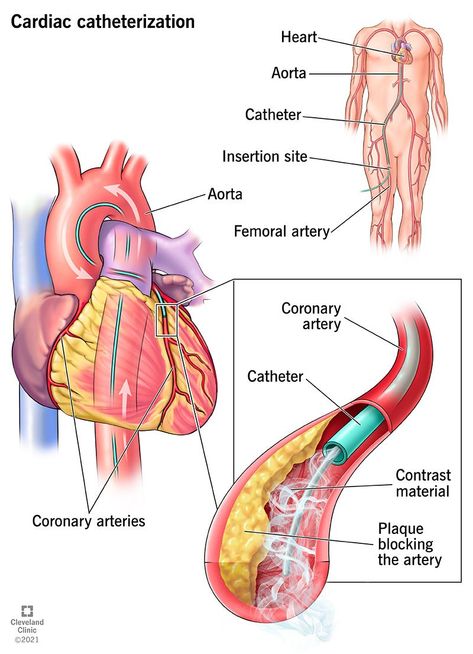 Heart Catheterization, Heart Pressure, Catheter Insertion, Cardiac Sonography, Vascular Ultrasound, Chest Discomfort, Nursing School Essential, Medical Pictures, Cardiac Nursing