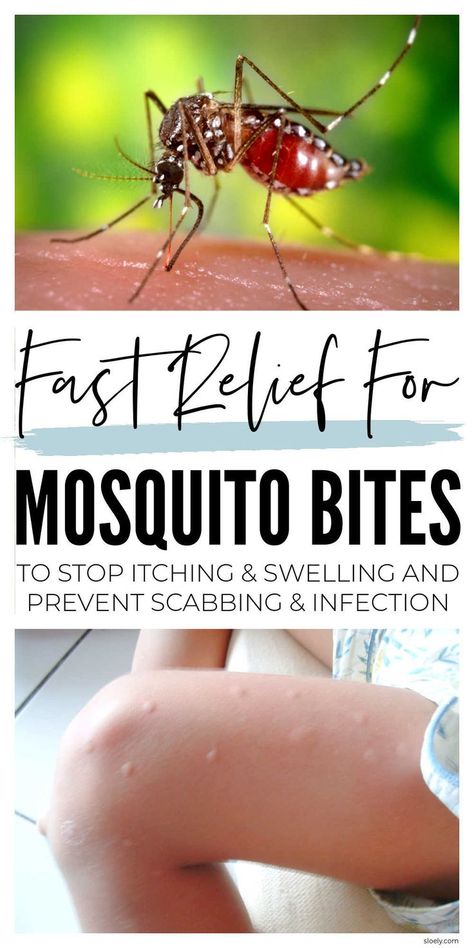 Mosquito Bite Relief Mosquito Bites Remedy, Misquote Itch Relief Diy, Essential Oil For Mosquito Bites Itch Relief, How To Stop Itching From Mosquitos, Diy Itch Relief Insect Bites, Natural Mosquito Bite Relief, How To Soothe Mosquito Bites, Natural Remedy For Mosquito Bites, Home Remedy For Mosquito Bites