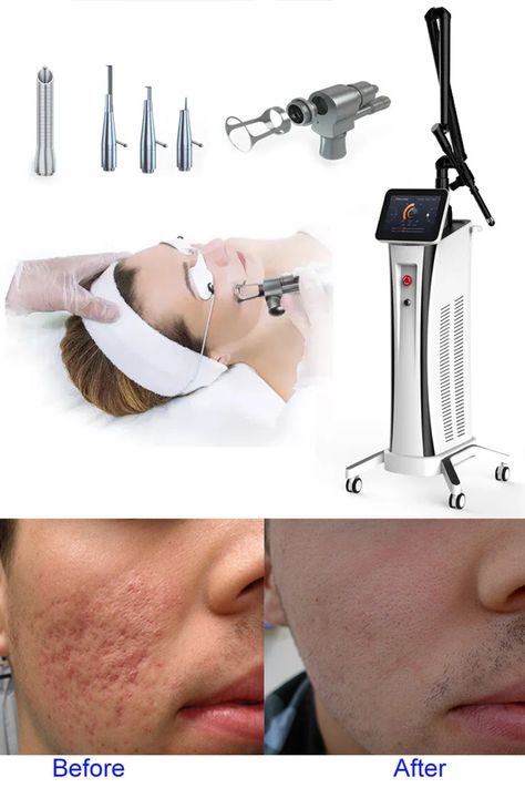 The CO2 laser skin resurfacing machine system uses a high-energy laser to create orderly conical holes in the skin, which can effectively stimulate collagen growth and sufficiency. Bvlaser Bestview is a dermatology CO2 laser machine factory manufacturer, we have the best CO2 fractional laser machine sale. Carbon Laser, Flawless Skin Care, Laser Skin Resurfacing, Fractional Laser, Laser Resurfacing, Face Care Routine, Beauty Room Design, Aesthetic Medicine, Skin Resurfacing