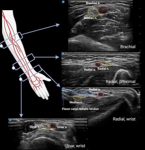 Abdomen Ultrasound Protocol, Ultrasound Technician School, Medical Sonography Student, Diagnostic Medical Sonography Student, Ultrasound School, Ultrasound Physics, Cardiac Sonography, Vascular Ultrasound, Sonography Student