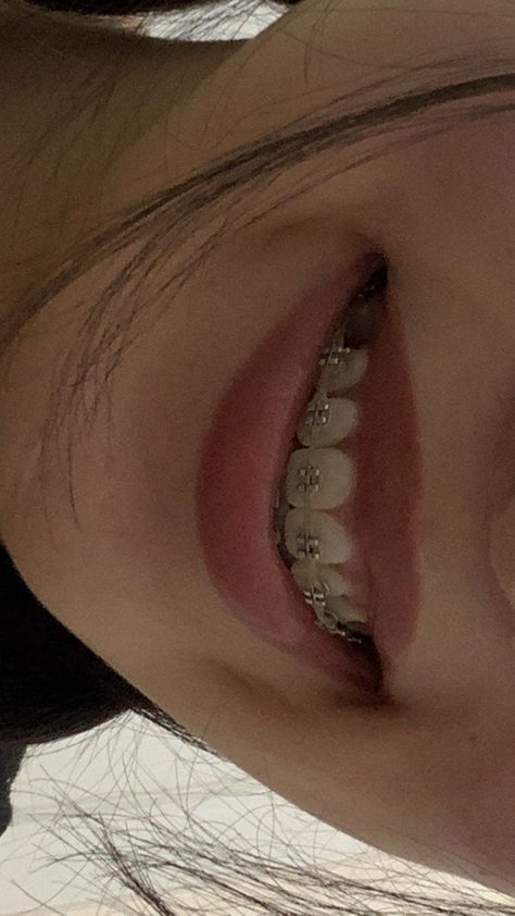 White Teeth Braces, Straight Teeth Braces, Braces Vision Board, Silver Braces Aesthetic, Good Teeth Aesthetic, Straight Teeth With Braces, Brace Aesthetics, Powerchain Braces Aesthetic, Pink Braces Aesthetic