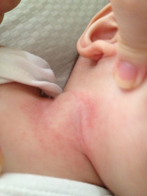 How to Treat Neck Rashes for Your Baby Heat Rash Remedy For Babies, Baby Neck Rash, Skin Rash Remedies, Heat Rash Remedy, Home Remedies For Rashes, Baby Rashes, Types Of Skin Rashes, Baby Skin Rash, Neck Rash