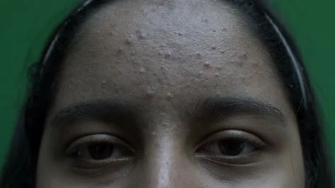 View Of Female Teenager's Forehead With Acne. Close Up, Green Screen, #AD ,#Teenager#Forehead#Female#View Acne On Forehead, Clear Skin Forehead, Fungal Acne On Forehead, What Does Forehead Acne Mean, Forehead Acne Cause, Forehead Acne, Free Footage, Fall Wallpaper, Stock Footage