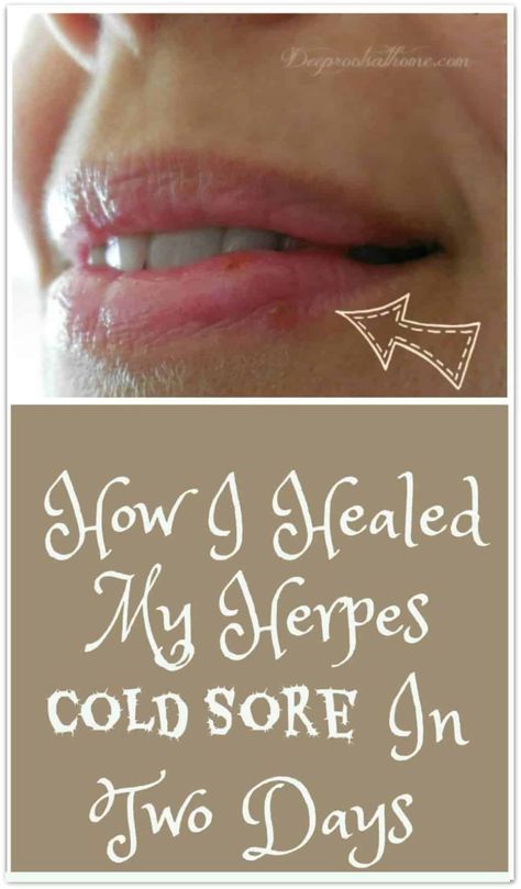 Healthy Woman, Cold Sores, Canker Sore, Cold Sores Remedies, Cold Sore, Natural Lips, Face Scrub, Oral Health, Three Days