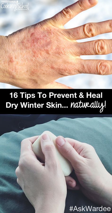 Does dry winter skin keep you scratching or in pain? Do you feel like you can't get enough lotion to heal your dry, cracking, or bleeding skin? Watch, listen, or read for my 16 tips to prevent and heal dry winter skin naturally, plus learn the BEST things to put on your skin to keep it moisturized (hint: it's NOT lotion!). Severe Dry Skin Remedies, Dry Skin Remedies For Body Winter, Best Lotion For Dry Skin Winter, Dry Hands Remedy, Homemade Creams, Scalp Spa, Medicine Recipes, Dry Hand Skin, Medical Tips