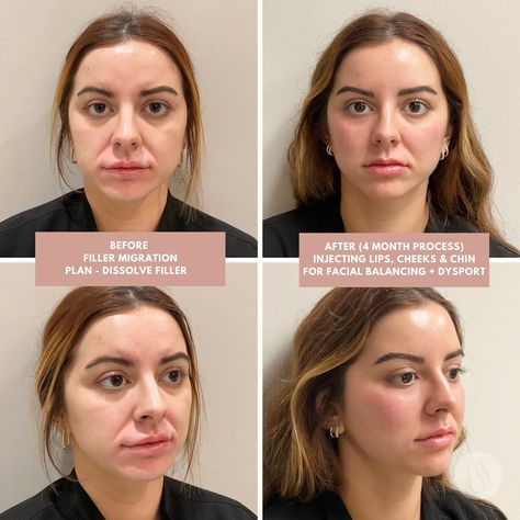 ✨ Fresh Face Friday ✨ Trust the process, trust your 𝗲𝘅𝗽𝗲𝗿𝗶𝗲𝗻𝗰𝗲𝗱 injector, and embrace the power of facial balancing! Our patient came to us with filler migration, Leslie Guilbeaux, FNP-C, worked her magic to restore and enhance her natural beauty. By dissolving the old filler and strategically placing new products in the cheeks, lips, and chin, we achieved a harmonious balance that enhances her features in all the right ways. Facial balancing isn’t just about changing one area; it’s abou... Face Balancing Fillers, Facial Balancing Filler, Kpop Plastic Surgery, Facial Balancing, Jaw Reduction Surgery, Nose Plastic Surgery, V Line Surgery, Fuller Lips Naturally, Face Threading