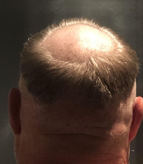 My dad decided the full Friar Tuck haircut was the way to go Dad Haircut, Friar Tuck, Hair Fails, Way To Go, My Dad, Haircuts For Men, Fails, The Way, Hair Cuts