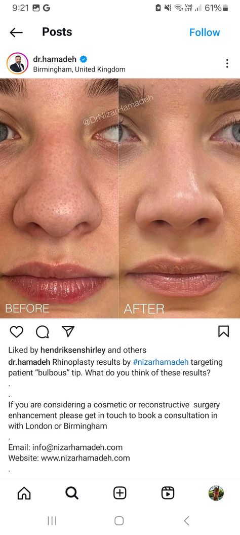 Small Nose Job, Wide Bridge Nose Rhinoplasty, Nostril Reduction Before And After, Bulbous Nose Job, Nose Job Bulbous Tip, Nose Job Before And After Front View, Nose Job Front Profile, Button Nose Nose Job, Nose Job Natural