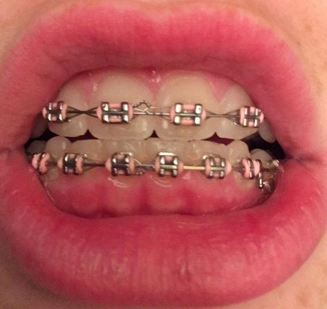 Braces Pink, Pink Braces, Natural Teeth Whitening Diy, Cute Braces Colors, Teeth Aesthetic, Adult Braces, Braces Tips, Getting Braces, Membentuk Alis