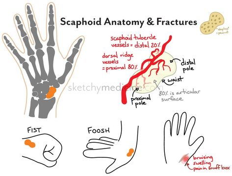 Carpal Bones, Scaphoid Fracture, Dressage Videos, Cranial Nerves Mnemonic, Ear Reflexology, Pa Life, Medical Study, Complex Regional Pain Syndrome, Pharmacology Nursing