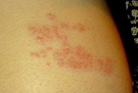 What you need to know about shingles symptoms and what causes shingles. Natural treatments and home remedies for shingles can help to treat herpes zoster virus? Is shingles contagious? Yes, it can be and it depends on what kind of blisters you have. Homeopathy is a great way to treat shingles. Are Shingles Contagious, What Causes Shingles, Shingles Symptoms, Treating Shingles, Shingles Rash, Recovering From Surgery, Infectious Diseases, Natural Home Remedies, Homeopathy