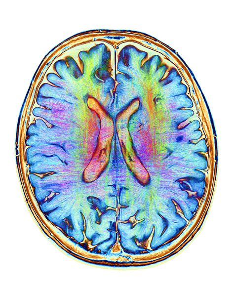 Arkuda: Changing the Trajectory of Neurodegenerative Disease Neuro Wallpaper, Neurodegenerative Disease, Brain Mri, Palm Springs Pool Party, Scan Photos, Mri Brain, Clown Dress, White Matter, Brain Scan