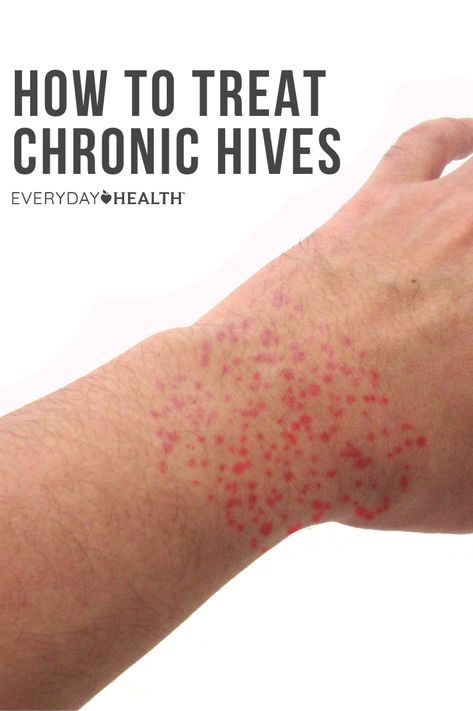 When it comes to treating hives, there are many home remedies that can help. Doctors say DO moisturize your skin, but skip the over-the-counter anti-itch creams (which can actually make the hives worse). How To Treat Hives, Remedies For Hives, Allergy Hives, Home Remedies For Hives, Itching Remedies, Types Of Skin Rashes, Hives Remedies, Chronic Hives, The Hives