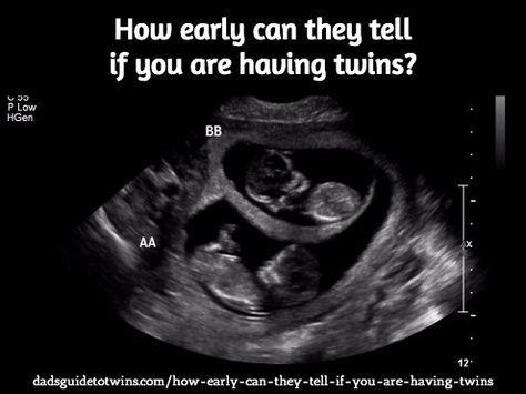 How early can they tell if you are having twins? Here are typical experiences: http://www.dadsguidetotwins.com/how-early-can-they-tell-if-you-are-having-twins/ Ultrasound Pictures 8 Weeks, 7 Weeks Pregnant Ultrasound, 7 Week Ultrasound, Twins Ultrasound, 4 Weeks Pregnant, 7 Weeks Pregnant, 4d Ultrasound, Pregnancy Ultrasound, Having Twins