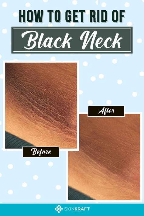 How To Get Rid Of Black Neck How To Get Rid Of A Black Neck, Neck Discoloration Remedies, Hyperpigmentation On Neck, Neck Hyperpigmentation, Neck Lightening, Dark Neck Remedies, Get Rid Of Dark Neck, Hyperpigmentation Remedies, Hyperpigmentation Black Skin