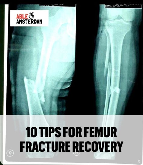 Here are my top tips to stay as comfortable and stress-free as possible during femur fracture recovery. Hip Fracture Recovery, Non Weight Bearing Exercises, Femur Fracture, Holistic Nursing, Physiotherapy Exercises, Hairline Fracture, Femur Bone, Hip Strengthening Exercises, Hip Fracture