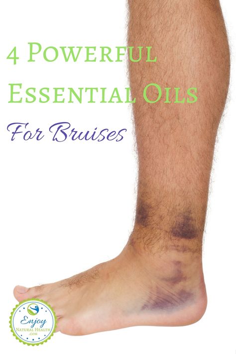 Bruising easily? These powerful oils will help you heal your bruises fast! Essential Oil For Bruising, Essential Oil Remedy, Yl Oils, Oil Remedies, Essential Oils Herbs, Essential Oils Health, Yl Essential Oils, Essential Oil Benefits, Living Essentials Oils