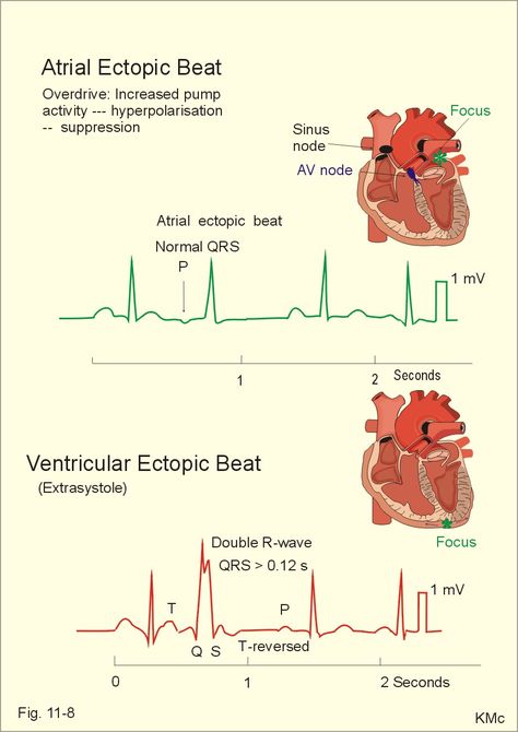 Atrial and ventricular ectopic beats Nursing Student Quotes, Holter Monitor, Physician Assistant School, Ekg Interpretation, Ecg Interpretation, Study Info, Human Physiology, Medical Student Study, Cardiac Nursing