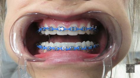 Power Chain Braces Colors Ideas, Power Chain Braces Colors, Braces Power Chain, Braces Colors Ideas Power Chains, Powerchain Braces Color, Sky Blue Braces, Royal Blue Braces, Colored Braces, Power Chains