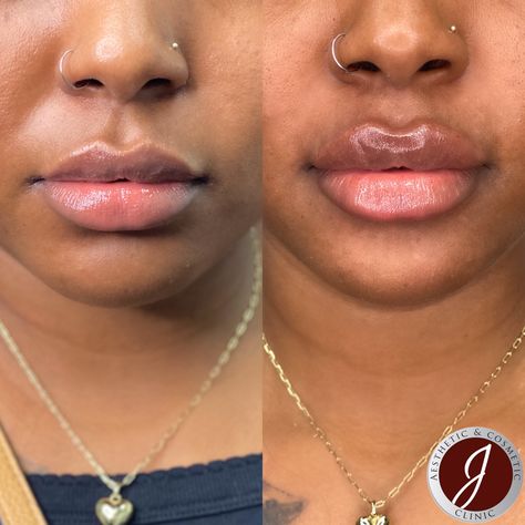 Lipolysis Injections Before And After, Needleless Lip Filler, Half Syringe Lip Filler Before And After, Russian Lips Filler Before And After, Lip Injections Before And After, Lip Flip Botox Before And After, Lip Fillers Before And After 1ml, Russian Lips Filler, Lip Filler Before And After