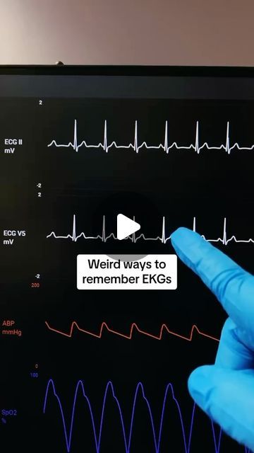 Amanda Draayer on Instagram: "EKGs Made Ridiculously Simple 🫀 👉Truth: Let’s be honest when we all first saw different EKGs, they just looked like squiggly lines. It used to feel impossible for me to interpret an EKG. Let me show you an easier way. A Normal Sinus Rhythm EKG has: 1️⃣ Spike that looks like a SAILBOAT ⛵ = QRS complex 2️⃣ 2 waves between each ⛵ = P wave + T wave 3️⃣ 60-100 BPM SINUS TACHYCARDIA = Spike ⛵ + 2 waves that come fast together. >100 BPM SINUS BRADYCARDIA = Spike ⛵ + 2 waves that are slowed apart. <60 BPM AFIB = Spike ⛵ + choppy or chaotic waves pattern on repeat AFLUTTER = Spike ⛵ + waves cut w/ a sawtooth 🪚 VTACH = Mountains of HUGE waves. 🌊🌊🌊 VTACH w/ pulse = cardiovert, VTACH w/o pulse = defibrillate VFIB = Pure chaos of waves w/ no spike ⛵. Have the V (V Sinus Rhythm, Med School Study, Nurse Skills, Normal Sinus Rhythm, Squiggly Lines, P Wave, Nursing School Essential, Nursing School Motivation, Medical School Life