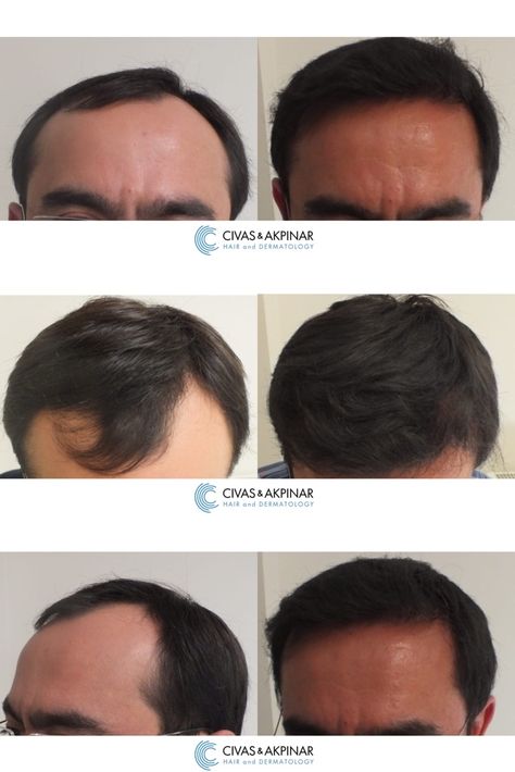 Procedure: FUE Hair Transplant
Number of Sessions: 1
Number of Grafts: 3000 Grafts
Results: 9 Months Post-Op results

FOR A FREE CONSULTATION AND QUOTATION, CONTACT US:

Website: https://www.civashairtransplant.com
Email: info@civashairtransplant.com
Whatsapp: +90 546 437 07 38

Prices: https://civashairtransplant.com/hair-transplant-prices-in-turkey/
Before&After Results: https://civashairtransplant.com/hair-transplant-before-after-results/ Scarring Alopecia, Eyebrow Transplant, Beard Transplant, Hair Transplant Procedure, Fue Hair Transplant, Hair Transplant Surgery, Hair Clinic, 1 Number, Post Op