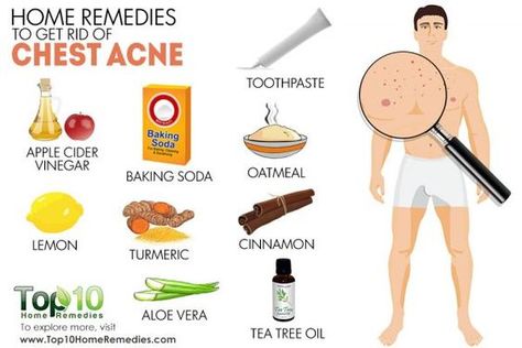 home remedies for chest acne Get Rid Of Chest Acne, Cystic Acne Remedies, Chest Acne, Face Fun, Top 10 Home Remedies, Face Cleaning, Acne Skincare, Natural Acne Remedies, Natural Acne