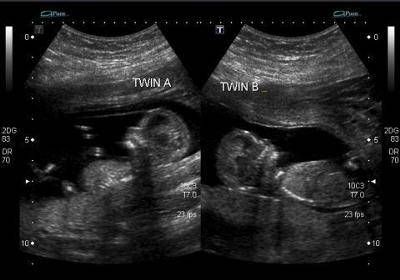 Fraternal Twins - 13 Weeks Ultrasound 13 Week Ultrasound, Boy Ultrasound, Fake Ultrasound, Twins Ultrasound, Baby Ultrasound Pictures, 13 Weeks Pregnant, Pregnancy Ultrasound, Twin Baby Boys, Baby Ultrasound