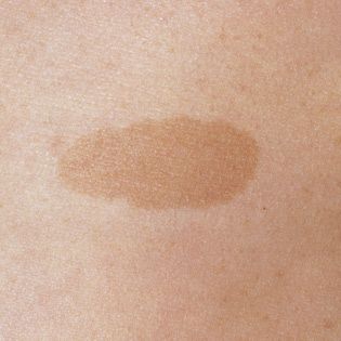 These flat patches on the skin can range in color from beige (coffee with a lot of milk) to light brown (coffee with a touch of milk). Brown Patches On Skin, Spots On Skin, Tuberous Sclerosis, Brown Spots On Skin, Best Face Serum, Turmeric Vitamins, Acne Overnight, Brown Spots Removal, Brown Spots On Face