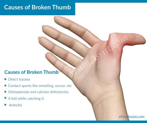 Broken Thumb, Types Of Injuries, Finger Injury, Calcium Deficiency, Sports Injury, Okay Gesture, Hockey, Basketball, Soccer