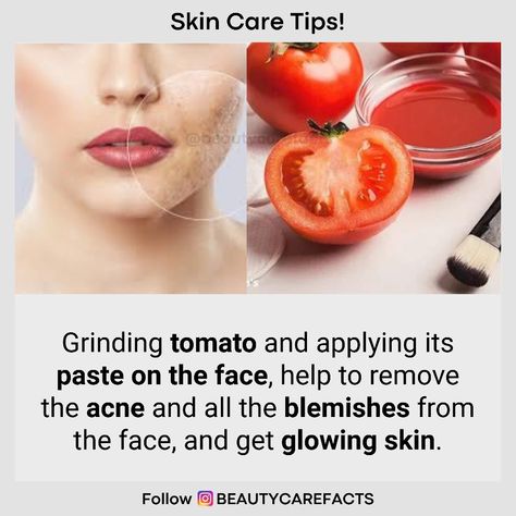 The juice of tomatoes helps in shrinking open pores caused by acne and the natural astringent properties present in tomatoes make it ideal for clearing blemishes. As far as the dark spots on the skin are concerned, the high lycopene content present in tomatoes helps in lightening these stubborn spots. . . Follow @beautycarefacts for natural beauty and health tips. . . Share with your friend👱👱‍♀️ or tag 😉 Double tap❤️ for more info🗣️ share + Tag your Friends. Tomato Benefits Skin, Tomato For Skin, Tomato Benefits, Tomato Mask, Man Pic, Skin Drinks, Open Pores, Tan Removal, Anniversary Wishes